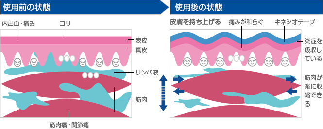 キネシオテーピング使用前と使用後イメージ
